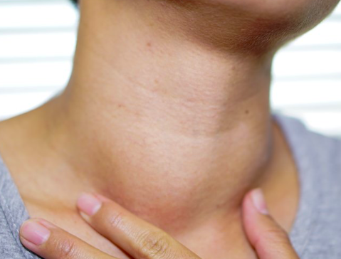 L'hyperthyroidie femme avec goitre