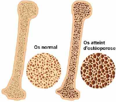 Schéma d'un os avec ostéoporose et d'un os sain